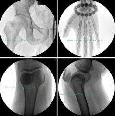 C-Arm Large Rotation System Trauma Surgery Digital X-ray Camera - Image 6