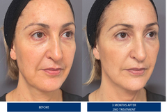 Fast Delivery Profhilo Buy Premium Quality Injectable for Skin Hydration and Anti Aging Wholesale Available - Image 4