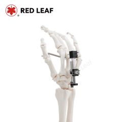 Universal Mini Palm External Fixator for Finger Fracture Orthopedic Surgical - Jiangsu Rixin Medical Equipment Co., Ltd.