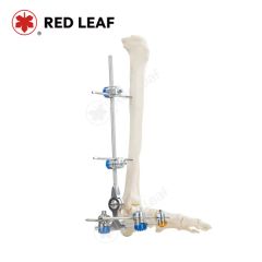 Combinational Ankle Fusion External Fixator Medical Fracture Solution Orthopedic Fixation - Jiangsu Rixin Medical Equipment Co., Ltd.
