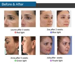 ADSS Powerful Skin Rejuvenation LED PDT Machine Bio-Light Therapy - Image 4