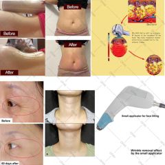 Ofan Eye Bag Removal Ultrasound Fat Reducing RF Equipment Skin Tighten Beauty Equipment - Image 6