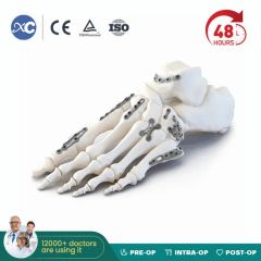 Titanium Orthopedic Implants Mini Bone Locking Plate for Foot and Ankle System - Image 2