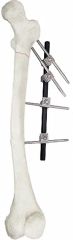 Adjustable External Fixator in White & Black, for Bone Fixation, Titanium Alloy - Image 2