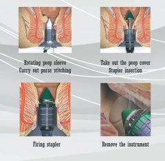 Hospital Minor Minimally Invasive Surgery Pph Medical Disposable Anorectal Staplers - Image 3