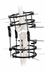 Adjustable External Fixator in White & Black, for Bone Fixation, Titanium Alloy - Image 4
