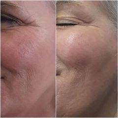 Fast Delivery Profhilo Buy Premium Quality Injectable for Skin Hydration and Anti Aging Wholesale Available - Image 2