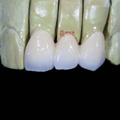 Customized Remote All Ceramic Teeth Supports Browsing Files in Various Formats Stl Ply Dcm Impression Model - Image 1