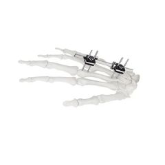 Surgical Instruments Orthopedic Fixation Pelvic External Fixator - Image 6
