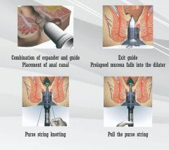 Hospital Minor Minimally Invasive Surgery Pph Medical Disposable Anorectal Staplers - Image 4