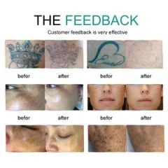 Advanced Pico Laser Hair Removal & Tattoo Removal System - Image 6