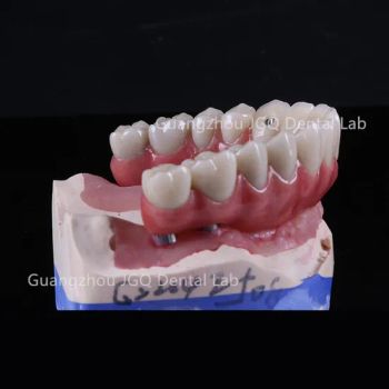 Cement Implant Crown and Bridge Dental Implants Dental Lab China Price - Guangzhou Jinguanqiao Industry Co., Ltd. - China