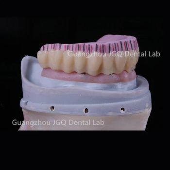 Zirconia Dentures Bridge Over Custom Milled Titanium Frame Dental Implants Cement-Retained - Guangzhou Jinguanqiao Industry Co., Ltd. - China