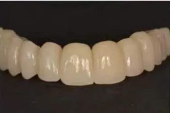 Kingch Full Denture Material PMMA Blocks Dental Lab CAD Cam Pink PMMA Discs - Qinhuangdao Silide Ceramic Technology Co., Ltd. - China