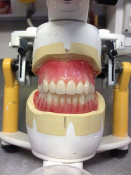 Implant Supported Removable Complete Denture En shenzhen Dental Lab - Shenzhen Myy Dental Technology Co., Ltd. - China