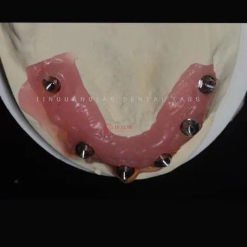 Guangzhou Dental Manufacturer Dental Implant Crowns and Bridge Immediate Implant Supported Dentures - Guangzhou Jinguanqiao Industry Co., Ltd. - China