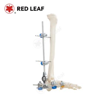Combinational Ankle Fusion External Fixator Medical Fracture Solution Orthopedic Fixation - Jiangsu Rixin Medical Equipment Co., Ltd. - China