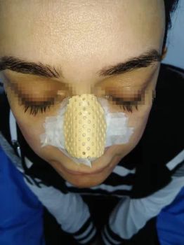 Aquaplast Thermoplastic Nasal Splint for Nose Cast Rhinoplasty Surgery Orthopedic Immobilization Brace Fracture Rehabilitation Fixation FDA CE ISO13485 - Shandong Yabin Medical Technology Co., Ltd. - China
