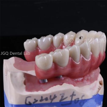 Dental Aesthetic Implant Zirconia Bridges Full Arch China Dental Lab Competitive Price - Guangzhou Jinguanqiao Industry Co., Ltd. - China