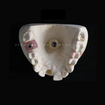 Dental Implant Crowns and Bridges The Best Option for Your Missing Teeth Dental Laboratory in China - Guangzhou Jinguanqiao Industry Co., Ltd. - China