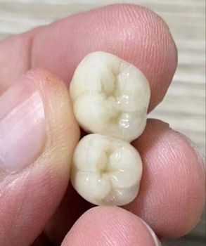 China Denture Dental Lab & Zirconia Dental Crown factories - Shenzhen Myy Dental Technology Co., Ltd. - China