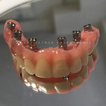 Choose China Dental Implants for Permanent and Reliable Solution to Missing Teeth with Wholesale Prices - Guangzhou Jinguanqiao Industry Co., Ltd. - China