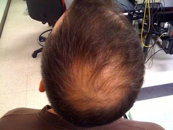 Hair Growth Treatment Services - ICLS - India