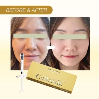 Popular China Product Facial Collagen Implant for Brightens Skin and Removes Dark - Dermax Medical Technology (Hebei) Co., Ltd. - China