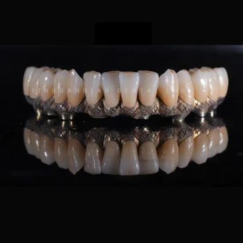 Dental Full Arch Implant Bridge with Titanium Bar and Screwed Zirconia Crowns for Dental Care - Guangzhou Jinguanqiao Industry Co., Ltd. - China