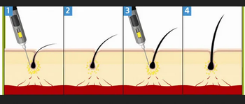 Stem Cell Hair Regrowth Service Target Structure Hair Follicle Papilla Stem Cell Type Mesenchymal Stem Cells Or Mscs Origin Of Hair Follicle Dermis, Mesodermal In - The Body Perfect - India
