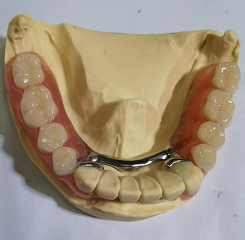 ShenZhen China Implant Dental Factory Custom Metal Ceramic Zirconia Crown and Bridges Good Price - Shenzhen Myy Dental Technology Co., Ltd. - China