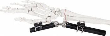 External Fixator for Bone Fixation, White & Black, Titanium Alloy Design - Suzhou Youbetter Medical Apparatus Co., Ltd. - China