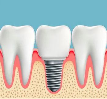 High Grade Dental Implants Dental Instruments HS Code 9021100000 Certification CE, FDA Origin Shandong China Trademark Foosin/, OEM - Foosin Medical Supplies Inc., Ltd. - China