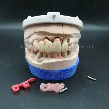 China Dental Lab Implant Crown and Bridges Enjoy High-Quality Oral Restoration Experience with Good Prices - Guangzhou Jinguanqiao Industry Co., Ltd. - China