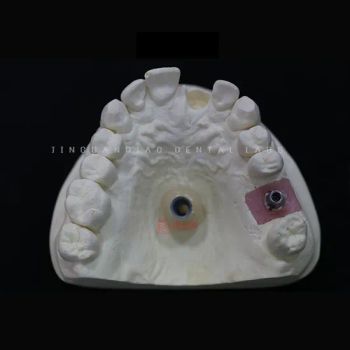 Digital Professional Dental Zirconia Crowns and Bridges Screwed for Dental Implant - Guangzhou Jinguanqiao Industry Co., Ltd. - China