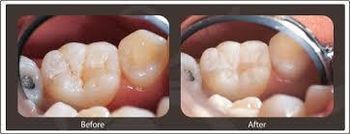 Sealants Services Drilling Required No Anesthesia Required No Procedure Complexity Simple Application Surface Chewing Surfaces Of Permanent - Dinesh Dental Care Clinic - India