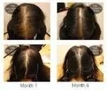Stem Cell N Prp For Hair Regrowth Price Per Sitting 4000/- Consultation Charges None Sitting Interval 15 To 20 Days Number Of Sittings Required 6 To - Skin Mekover - India