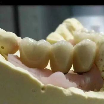 Dental Zirconia Abutment and Screwed Porcelain Crowns for Implant Dentures - Guangzhou Jinguanqiao Industry Co., Ltd. - China