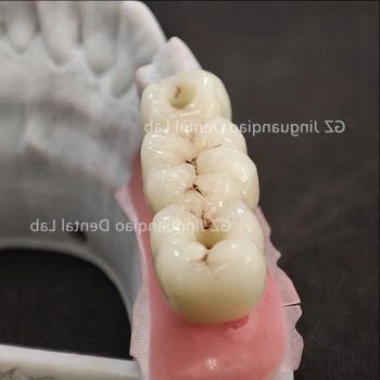 Replacing a Missing Tooth Free End 3 Unit Implant Products Dental Lab Custom Zirconia Crowns - Guangzhou Jinguanqiao Industry Co., Ltd. - China