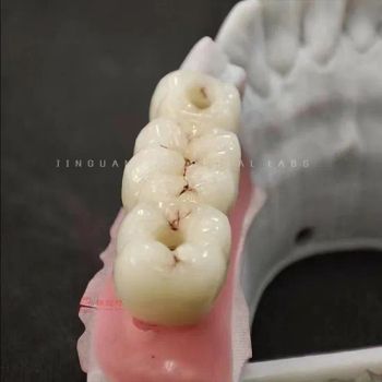 High Quality Dental Screwed Zirconia or Pfm Crowns and Bridge Support Dental Implant - Guangzhou Jinguanqiao Industry Co., Ltd. - China