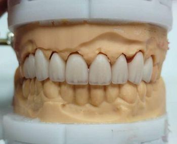 Total Implant PFM Bridge China Dental Lab Zirconia Dental Lab China Outsourcing - Shenzhen Myy Dental Technology Co., Ltd. - China