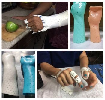 Orthopedic Medical Thermoplastic Splinting Material Fracture Bone Immobilization Splint - SHANDONG AOJIANYI MEDICAL TECHNOLOGY CO., LTD. - China
