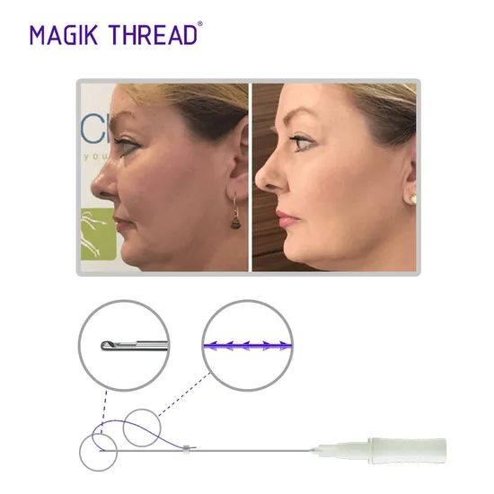 Disposable Medical Supplies Pdo Threads Korean Cog 4D Thread Cost Fox Eye Thread Lift with CE Approved - Image 4