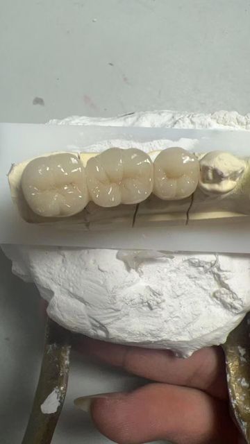 Total Implant PFM Bridge China Dental Lab Zirconia Dental Lab China Outsourcing - Image 4