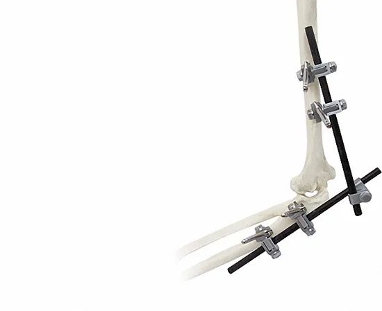 External Fixator for Bone Fixation, White & Black, Titanium Alloy Design - Image 4