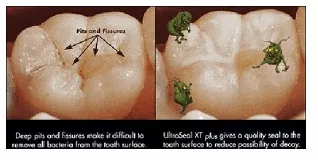 Involved In Preventive Dentistry Fluoride Application Treatment To Help Teeth Resist Decay Filling Inspection Check For Good Repair And No Rough - Image 1