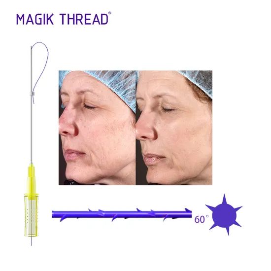 Disposable Medical Supplies Pdo Threads Korean Cog 4D Thread Cost Fox Eye Thread Lift with CE Approved - Image 6