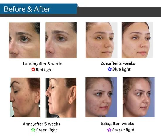 ADSS Powerful Skin Rejuvenation LED PDT Machine Bio-Light Therapy - Image 4