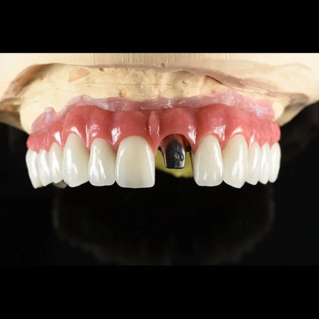 Implant Supported Removable Complete Denture En shenzhen Dental Lab - Image 3