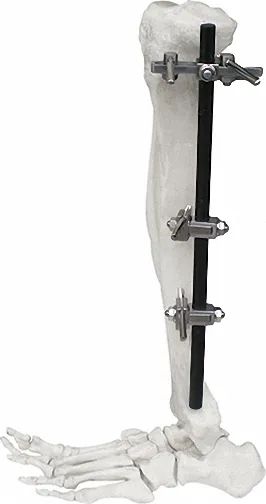External Fixator for Bone Fixation, White & Black, Titanium Alloy Design - Image 6